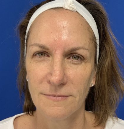 BBL Laser Before & After Patient #2024