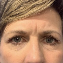 Blepharoplasty Before & After Patient #2484