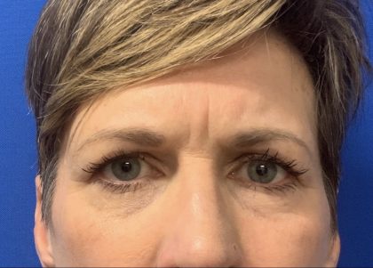 Blepharoplasty Before & After Patient #2484