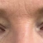 Blepharoplasty Before & After Patient #2026