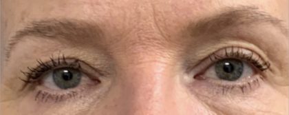 Blepharoplasty Before & After Patient #2026