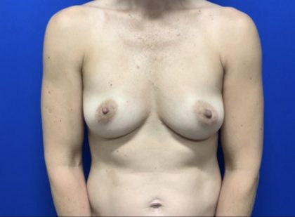 Breast Augmentation Before & After Patient #2030