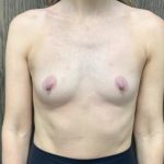 Breast Augmentation Before & After Patient #2029