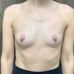Breast Augmentation Before & After Patient #2029