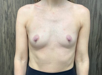 Breast Augmentation Before & After Patient #2029