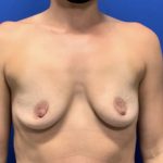 Breast Augmentation Before & After Patient #2038