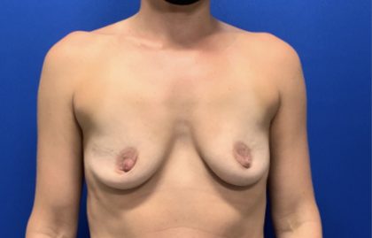 Breast Augmentation Before & After Patient #2038
