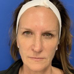 BBL Laser Before & After Patient #2024