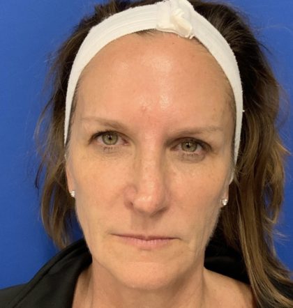 BBL Laser Before & After Patient #2024