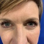 Blepharoplasty Before & After Patient #2484