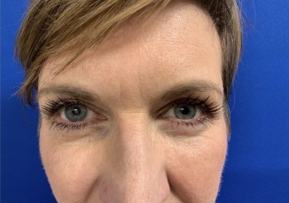 Blepharoplasty Before & After Patient #2484