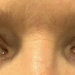 Blepharoplasty Before & After Patient #2026