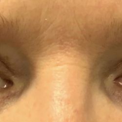 Blepharoplasty Before & After Patient #2026