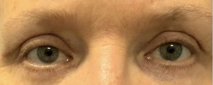Blepharoplasty Before & After Patient #2026