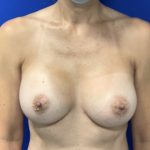 Breast Augmentation Before & After Patient #2030