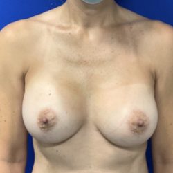 Breast Augmentation Before & After Patient #2030