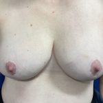 Breast Lift Before & After Patient #2059