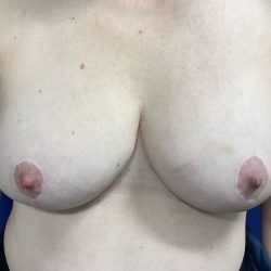 Breast Lift Before & After Patient #2059