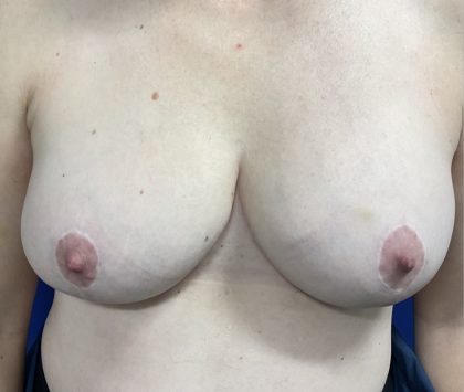 Breast Lift Before & After Patient #2059