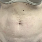 Tummy Tuck Before & After Patient #2485