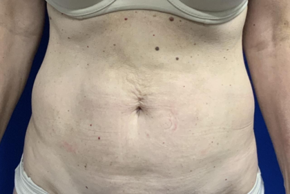 Tummy Tuck Before & After Patient #2485