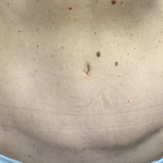 Tummy Tuck Before & After Patient #2485