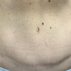 Tummy Tuck Before & After Patient #2485