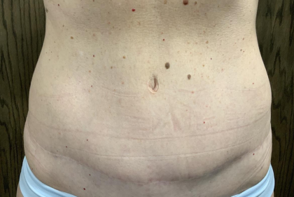 Tummy Tuck Before & After Patient #2485