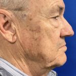BBL Laser Before & After Patient #2025