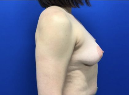 Breast Augmentation Before & After Patient #2033