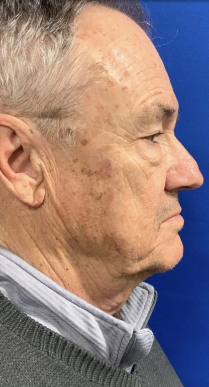 BBL Laser Before & After Patient #2025
