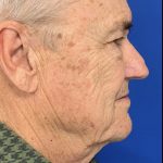 BBL Laser Before & After Patient #2025