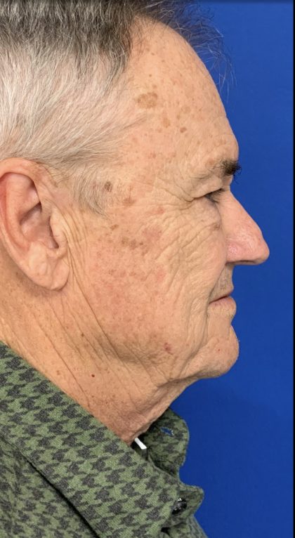 BBL Laser Before & After Patient #2025