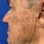 BBL Laser Before & After Patient #2025