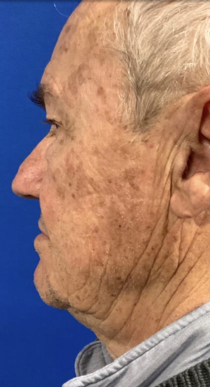 BBL Laser Before & After Patient #2025