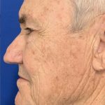 BBL Laser Before & After Patient #2025