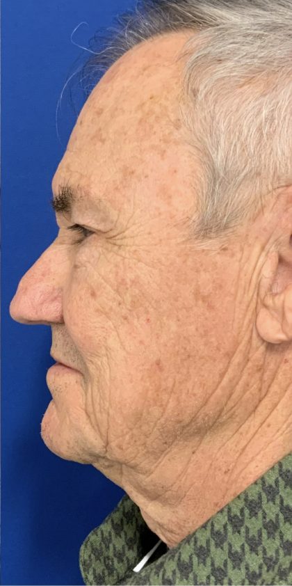 BBL Laser Before & After Patient #2025