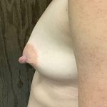 Breast Augmentation Before & After Patient #2037