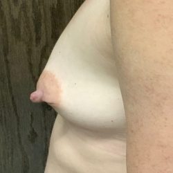 Breast Augmentation Before & After Patient #2037