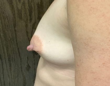 Breast Augmentation Before & After Patient #2037