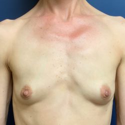 Breast Augmentation Before & After Patient #2036