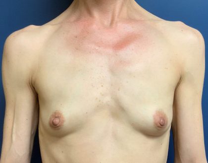 Breast Augmentation Before & After Patient #2036