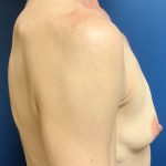 Breast Augmentation Before & After Patient #2036