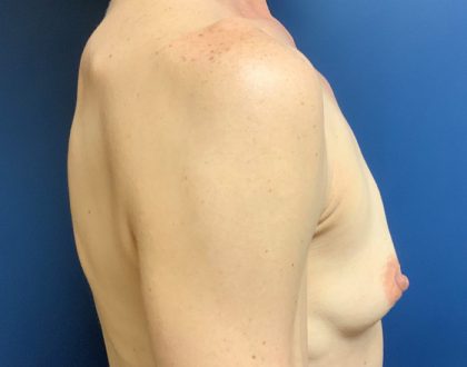 Breast Augmentation Before & After Patient #2036