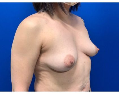 Breast Augmentation Before & After Patient #2033