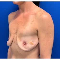 Breast Augmentation Before & After Patient #2032