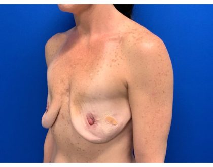 Breast Augmentation Before & After Patient #2032