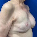 Implant Exchange Due to Ruptured Silicone Before & After Patient #2081
