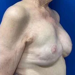 Implant Exchange Due to Ruptured Silicone Before & After Patient #2081