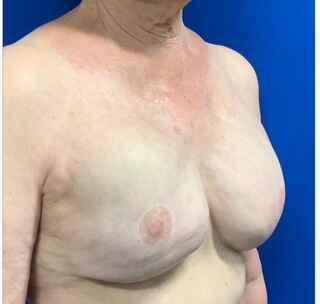 Implant Exchange Due to Ruptured Silicone Before & After Patient #2081